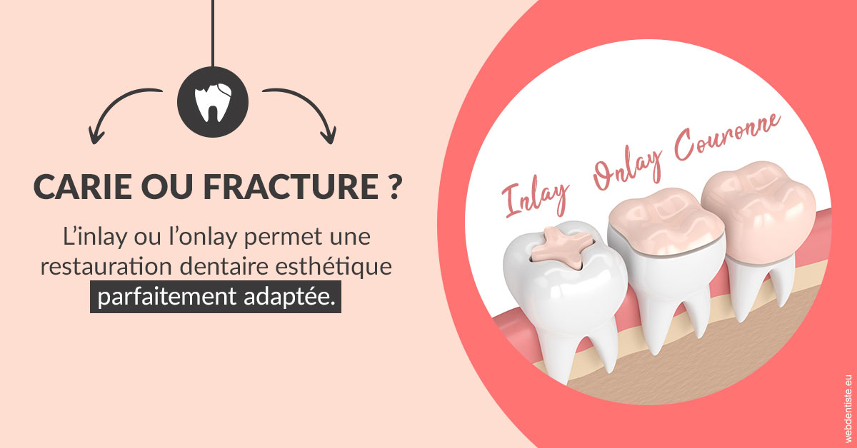 https://dr-lequart-christophe-frederic.chirurgiens-dentistes.fr/T2 2023 - Carie ou fracture 2