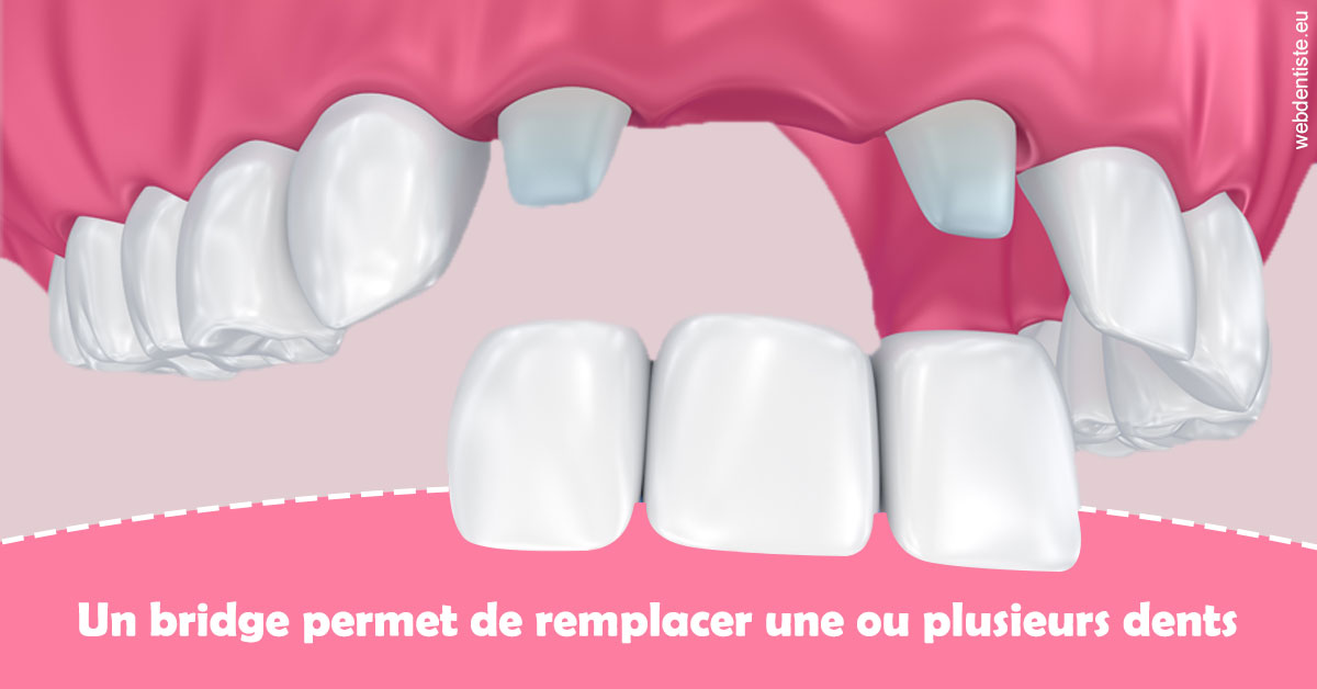 https://dr-lequart-christophe-frederic.chirurgiens-dentistes.fr/Bridge remplacer dents 2
