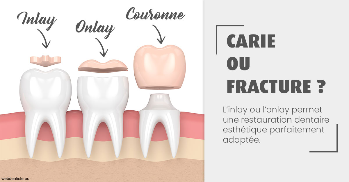 https://dr-lequart-christophe-frederic.chirurgiens-dentistes.fr/T2 2023 - Carie ou fracture 1