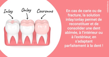 https://dr-lequart-christophe-frederic.chirurgiens-dentistes.fr/L'INLAY ou l'ONLAY 2